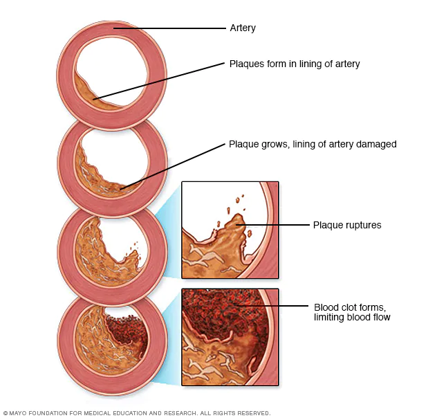 Průběh aterosklerózy