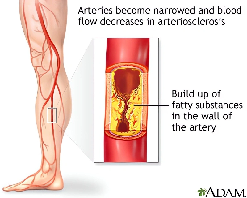 Ateroskleróza v nohou
